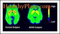 Az ADD és ADHD kifejezéseket felcserélhetően használták. A frissített kifejezés azonban a DSM IV szerint ADHD (figyelemhiányos hiperaktivitási zavar).